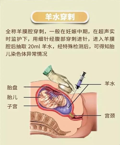 羊水穿刺，小孩的“晴天霹雳”？