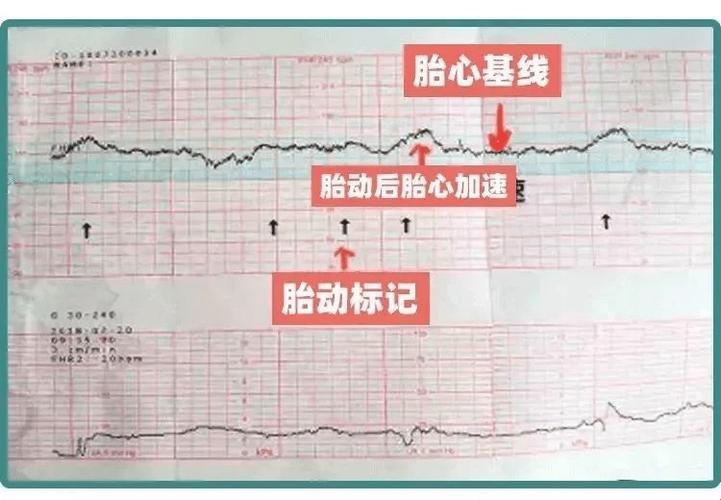 胎心监护？通关攻略比登天还难！