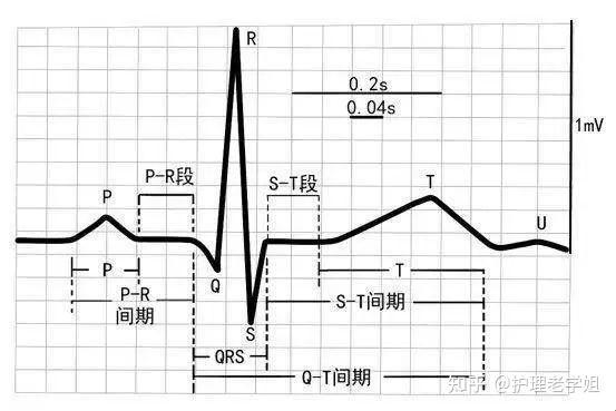 “心电图正常值”揭秘：笑出猪叫的另类解读