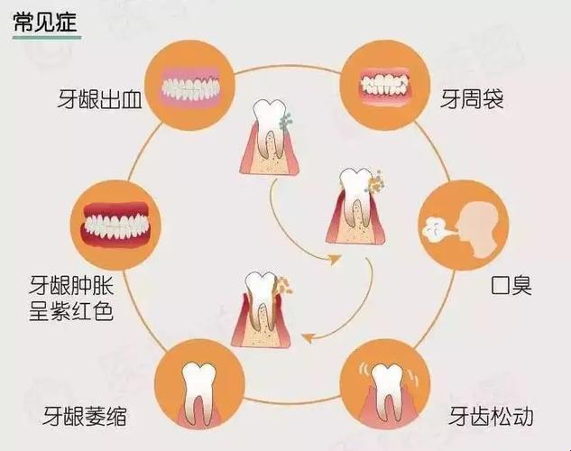 牙周炎一招见效？扯淡！