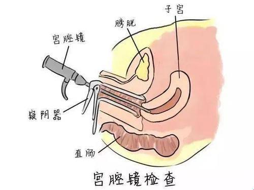 “宫腔镜清宫”是个啥玩意？微创手术界的“网红”还是“尴尬”的存在？