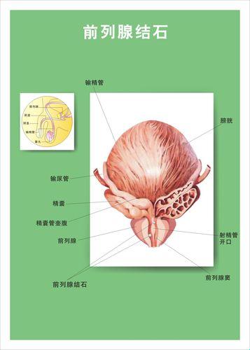 前列腺6mm结石，竟是我“自嘲”的硬核里程碑