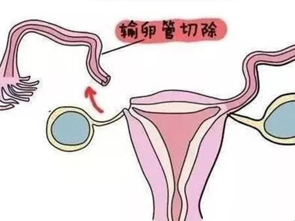 输卵管切除，女性双面镜：痛并快乐着的江湖