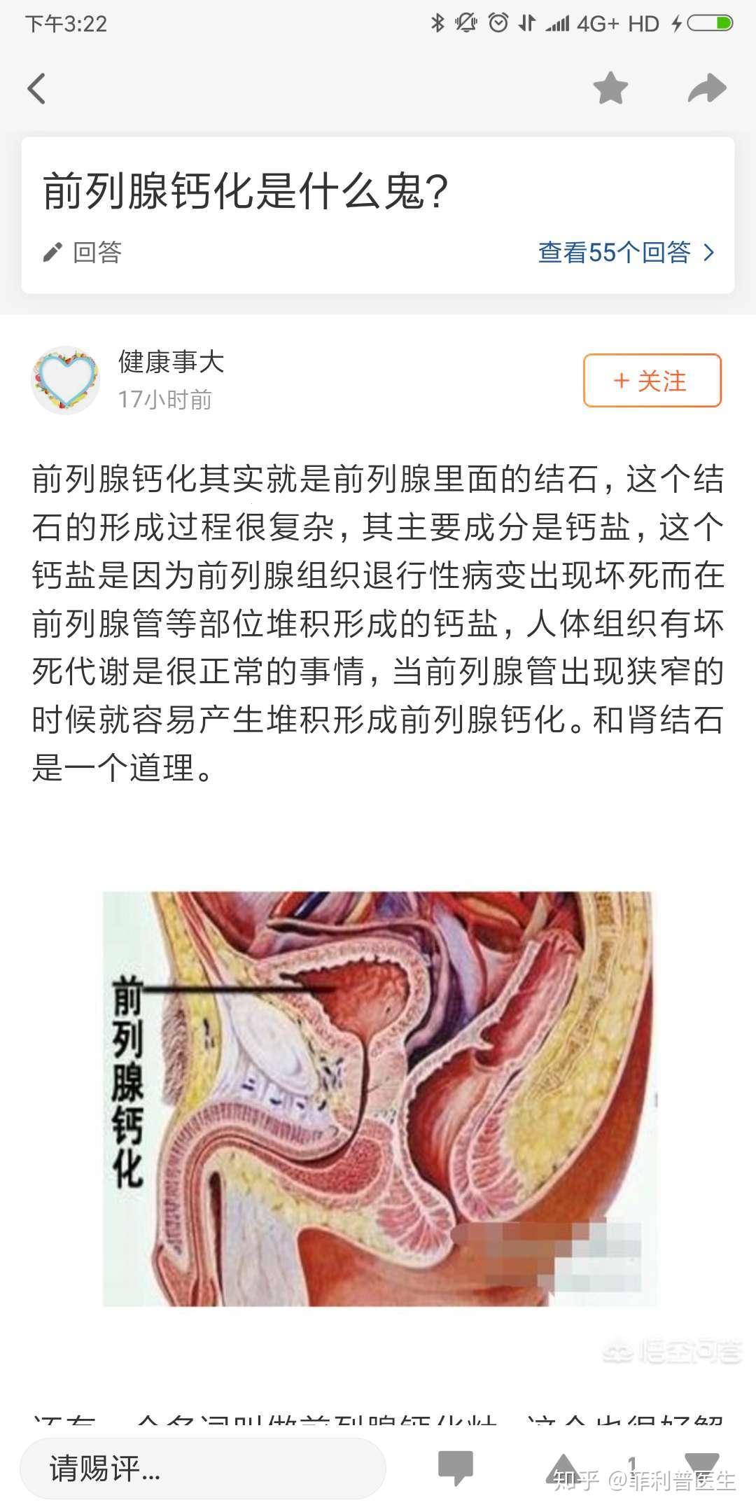 前列腺钙化，笑谈人生：哦，这该死的石头！