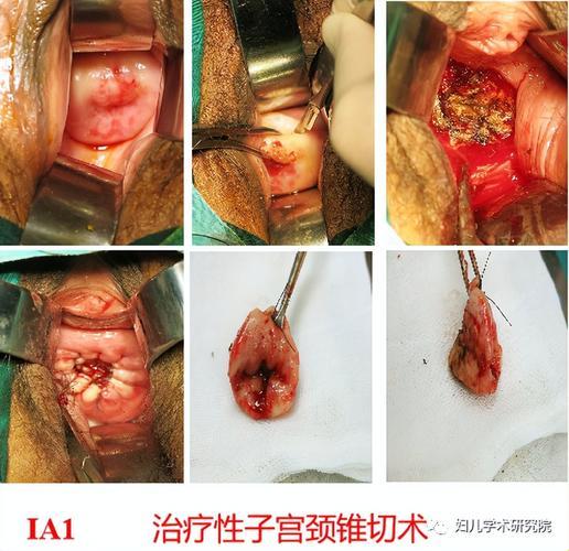 宫颈深喉：一探究竟，1a2期的宫颈癌究竟浸润多深？