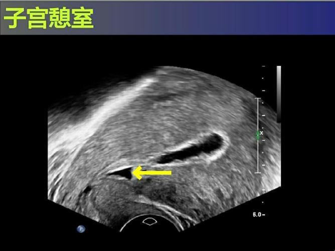 剖腹产后的惊喜：子宫憩室，你等得了多久？