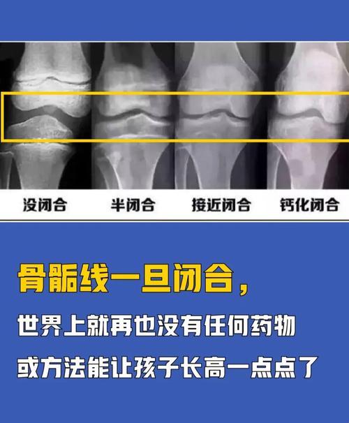 骨骼线的闭合小秘密：轻松破解成长密码