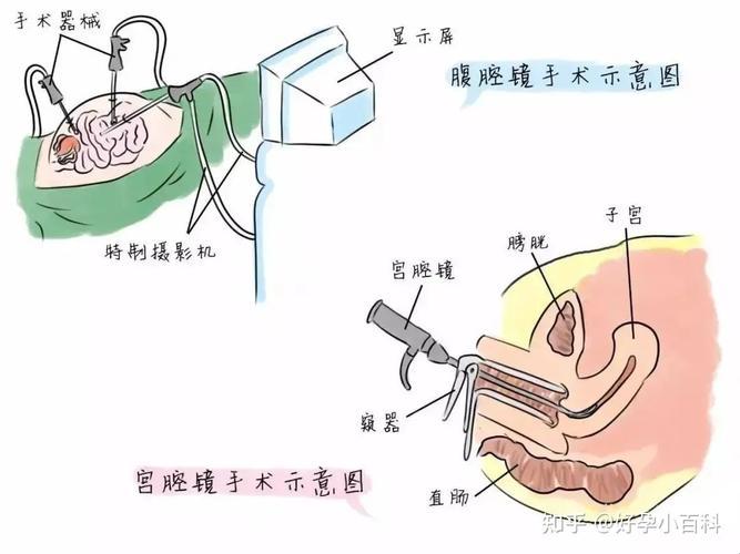 子宫内膜息肉，滚蛋吧！幽默夸张版治疗指南