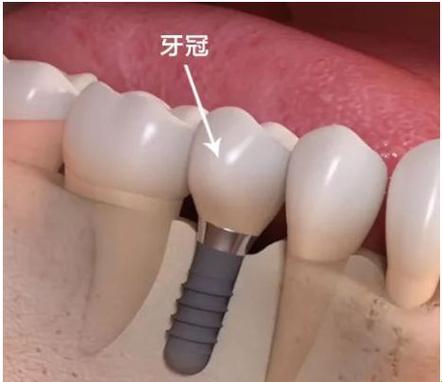 牙冠佩戴记：笑谈间的痛苦与荣耀