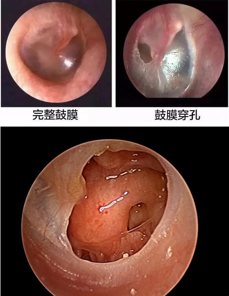 耳朵漏气，难道就是鼓膜穿孔？