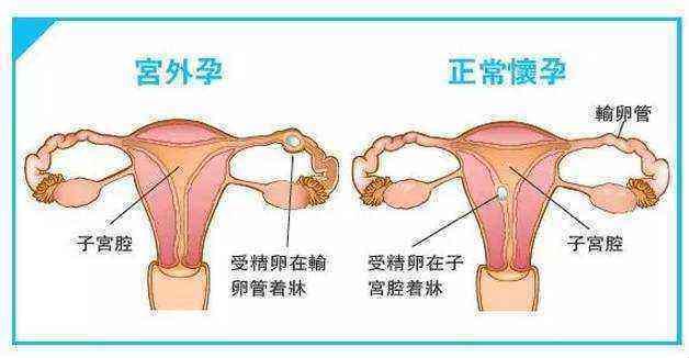 女性得了附件炎，笑谈“痛并快乐着”