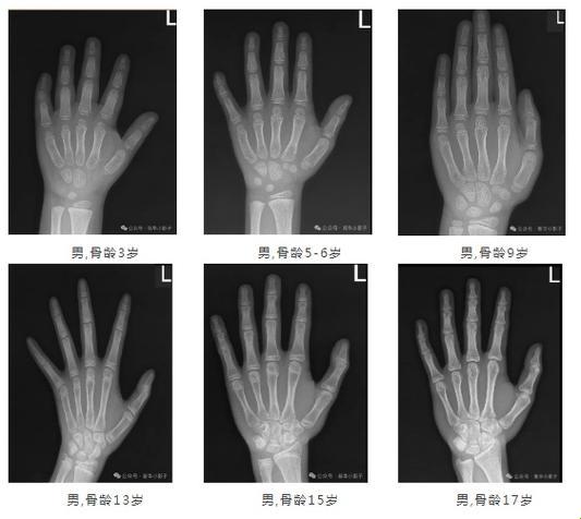 16岁，骨龄抗生长，激素战三个月：一场青春的荒诞剧