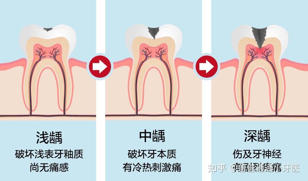 “牙齿的刑场”：揭秘根管治疗的滑铁卢