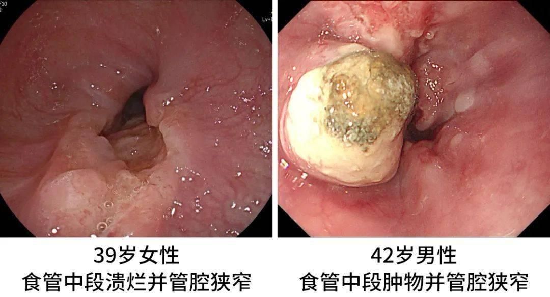 “临终食管癌老人，如何‘看出’生命尽头？”