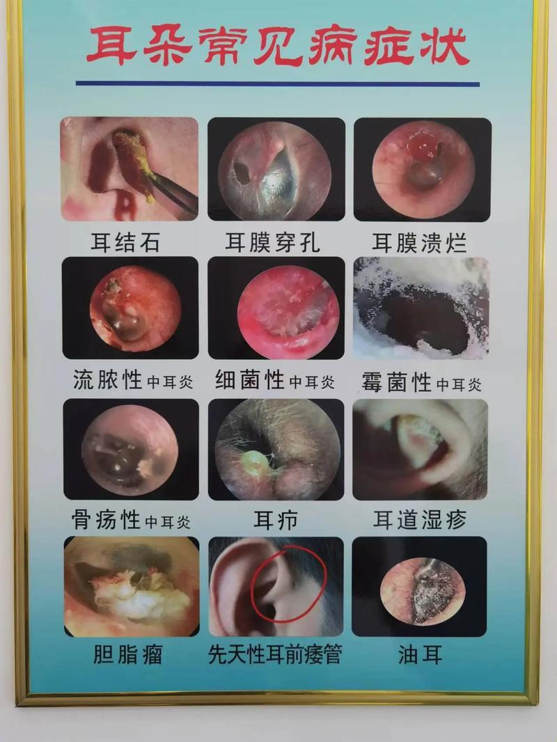 “耳膜穿孔”：破解“痛”点，寻觅“乐”点