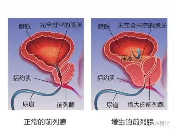 前列腺内腺增大，搞什么飞机？