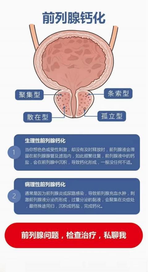 前列腺结石：幽默视角下的“石头记”