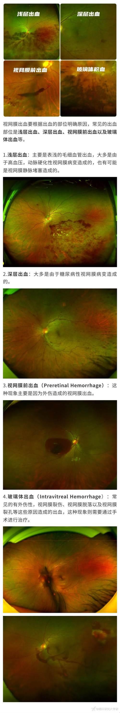 眼底“血战”：浅层出血斗深层出血