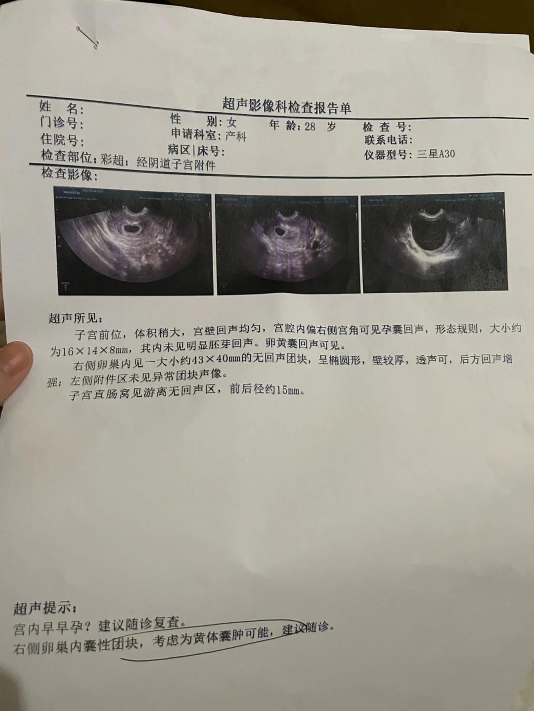 37天，宫内孕囊查得出吗？笑谈生育那些事儿