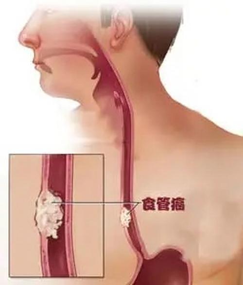 食道癌前期征兆：讽刺的健康警示