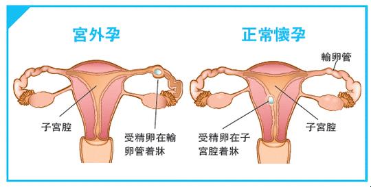 “孕”筹帷幄，别让“宫外孕”成了“校外训”