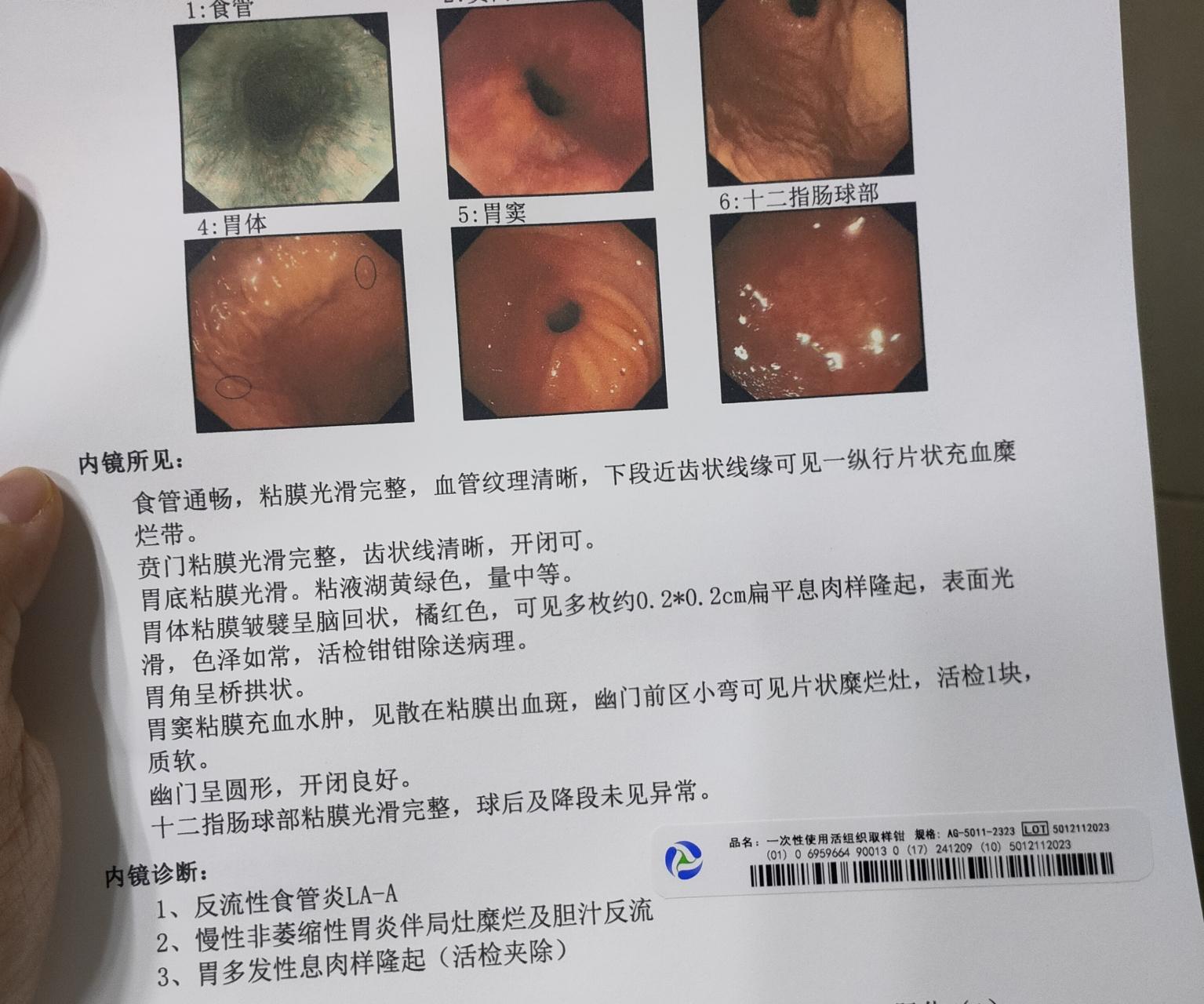 《笑谈反流性食管炎：百人团伙的酸体验》