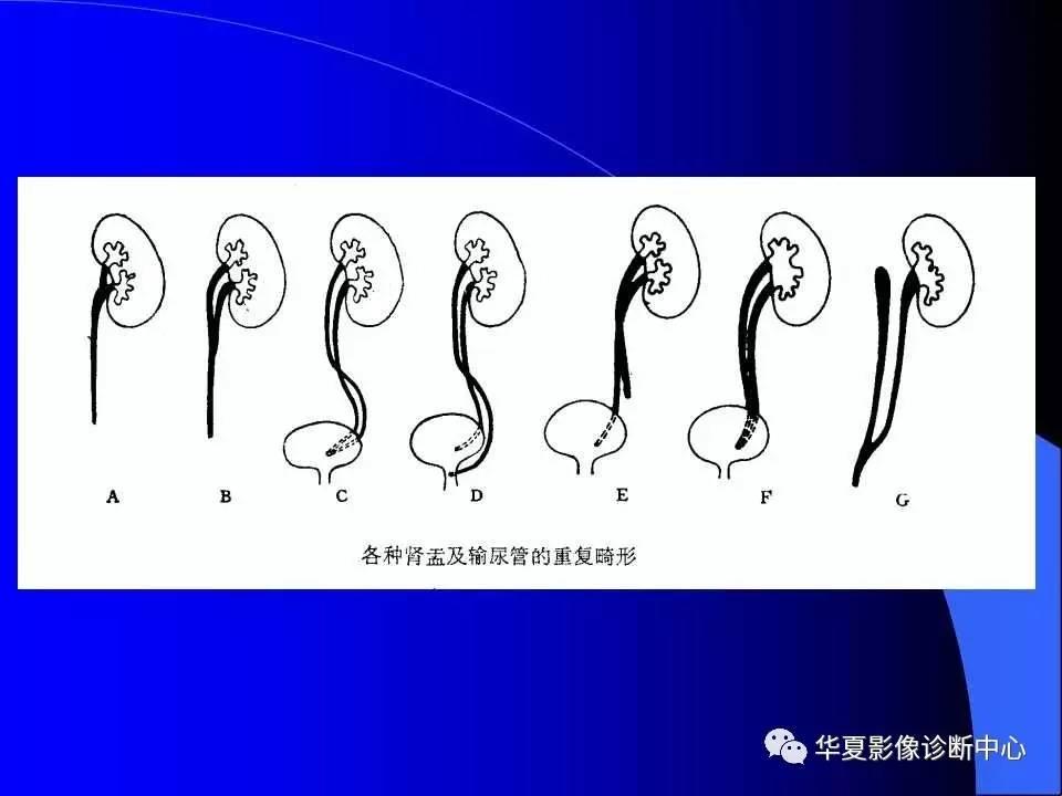 羊水少，泌尿系统畸形咋排除？诡异秘方大揭秘！