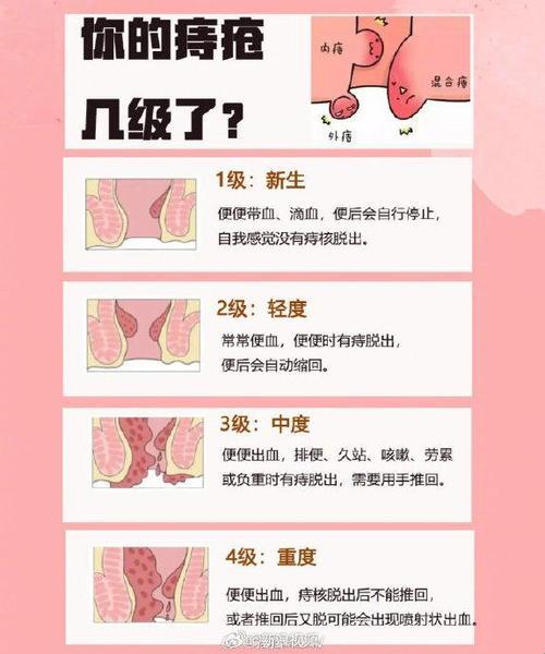 “菊”部有难，怎样“痔”心诊断？