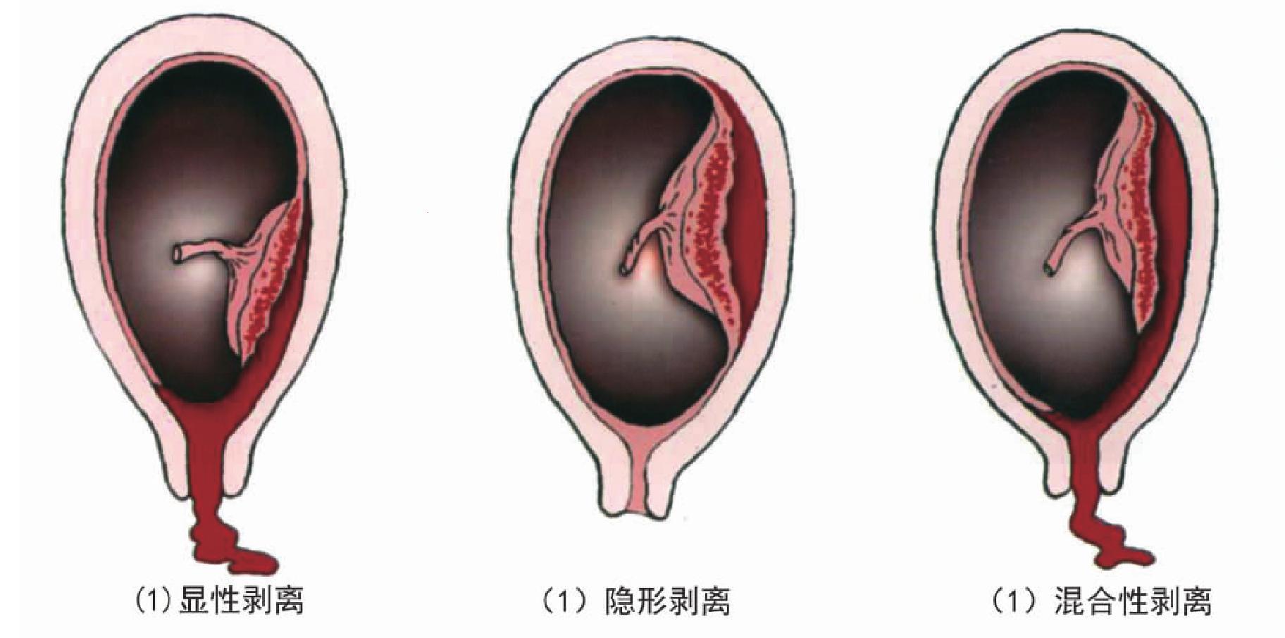 轻型胎盘早剥，剥离面积里的“诡谲艺术”