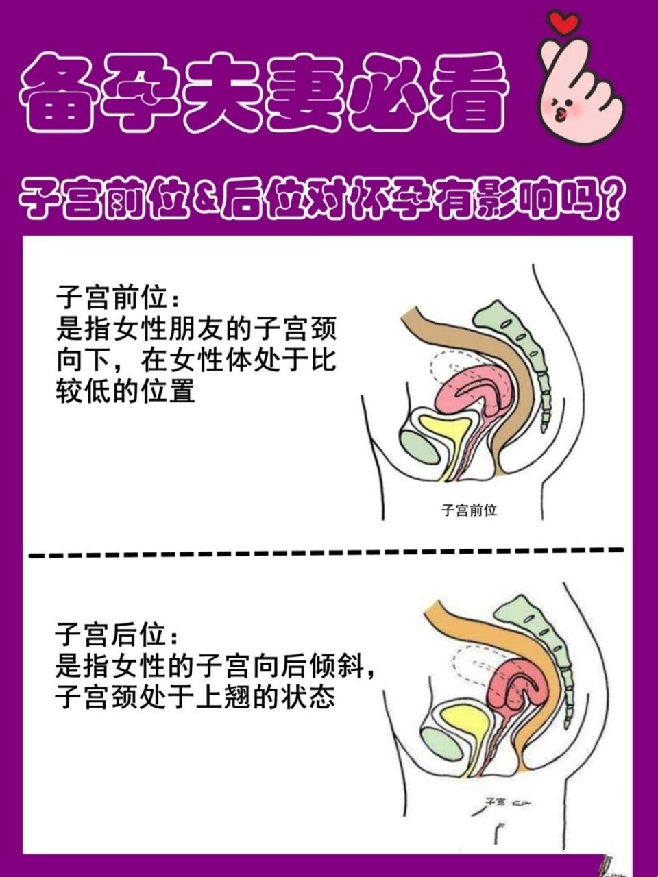 “后位”子宫，孕气打折？笑谈生育那些事儿