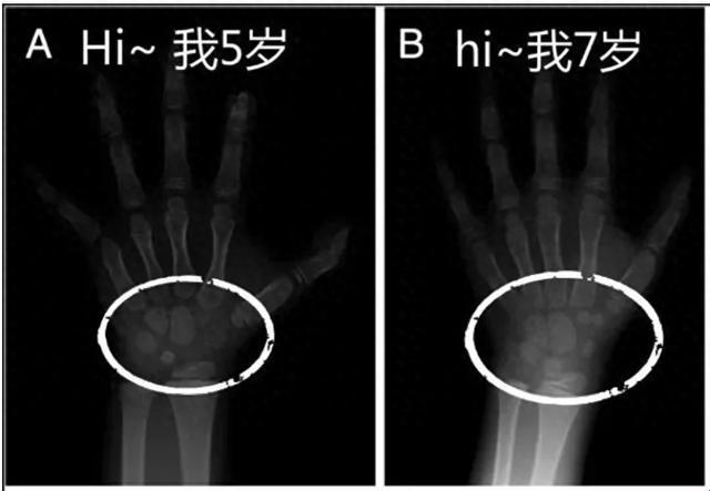 骨龄检测，CT还是X光？这是个史诗级的选择难题！