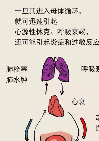 六种孕妈易遭羊水栓塞，躲不过的「栓塞风云」