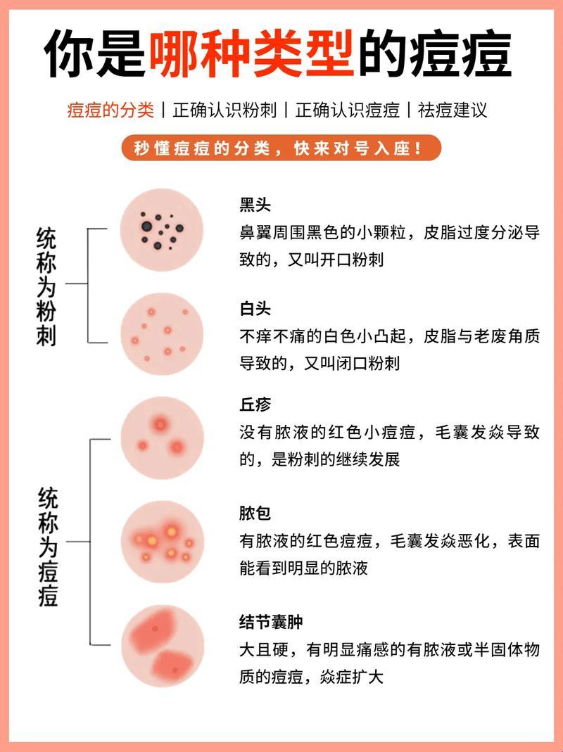 脸上小粉刺，滚蛋吧！搞笑版战“痘”攻略