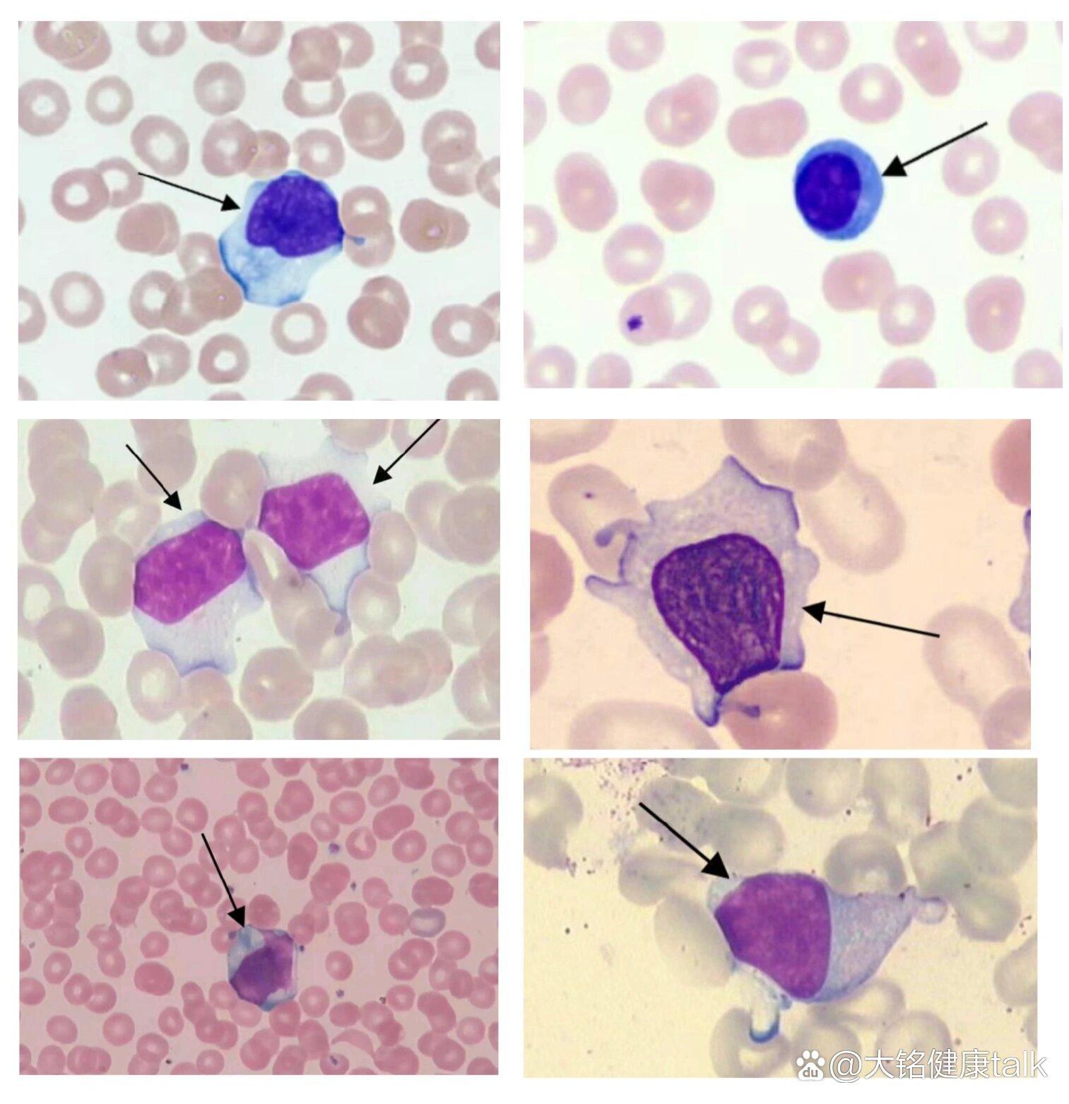 “异型淋巴”，笑谈细胞江湖里的那些“奇葩”