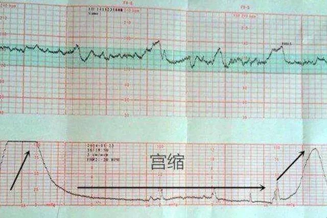 《胎心监护报告单，解读那些“心动”的瞬间》