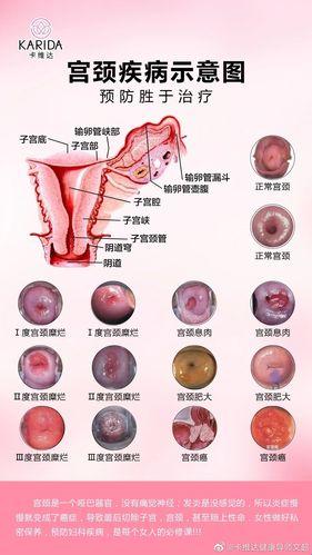 宫颈糜烂，哪里烂？探秘背后的真相