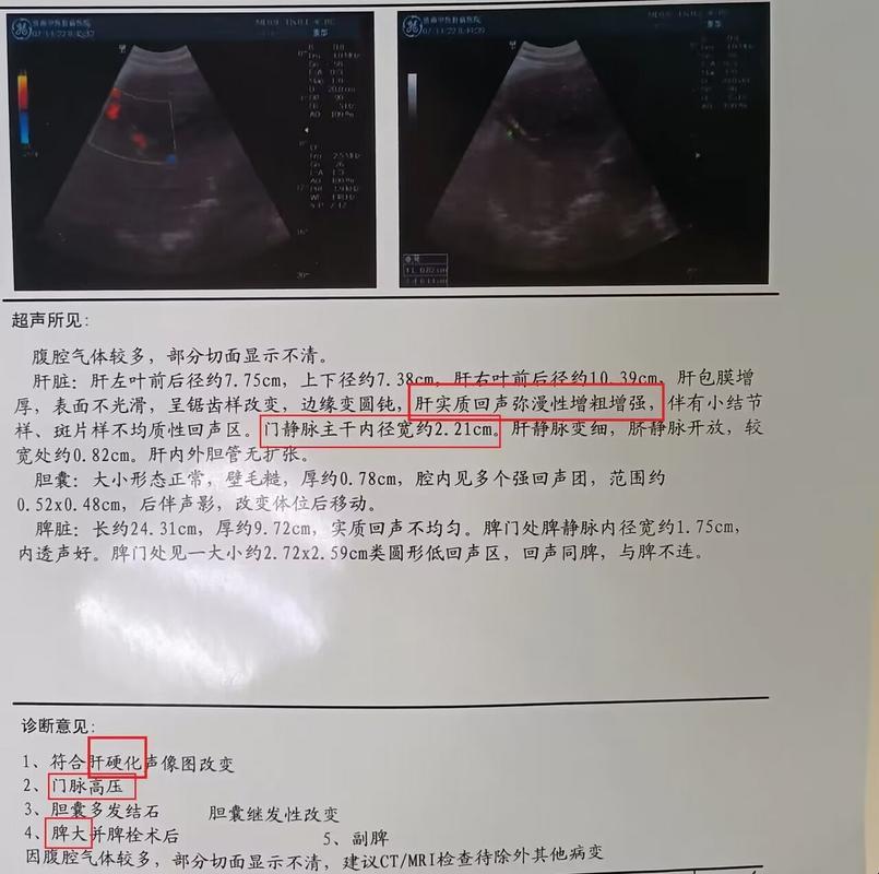 肝表面稍呈锯齿状？笑谈严重性！